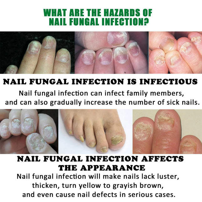 Jiasuying Ginger Nail Care Liquid, Repairs And Moisturizes Hand And Foot Nails, Makes Nails Shiny And Soft, And Improves Onychomycosis